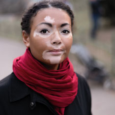 vitiligo